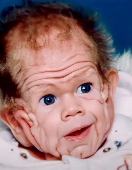 In 1993, This Boy Was Born With Enough Skin For A Five-Year-Old. But Wait Till You See Him Today