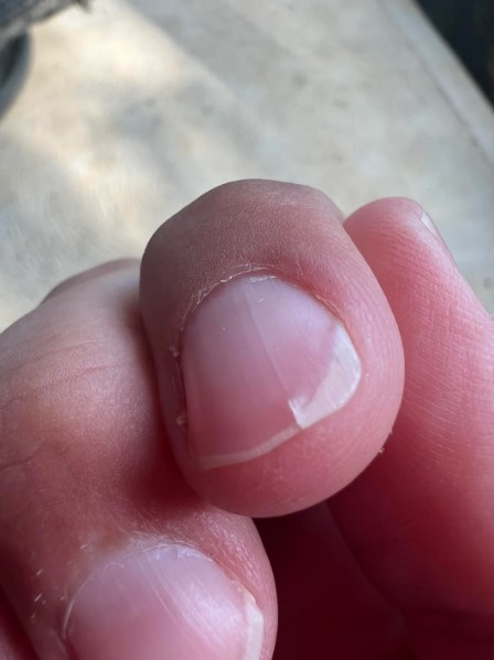 What does it mean when your nails split?